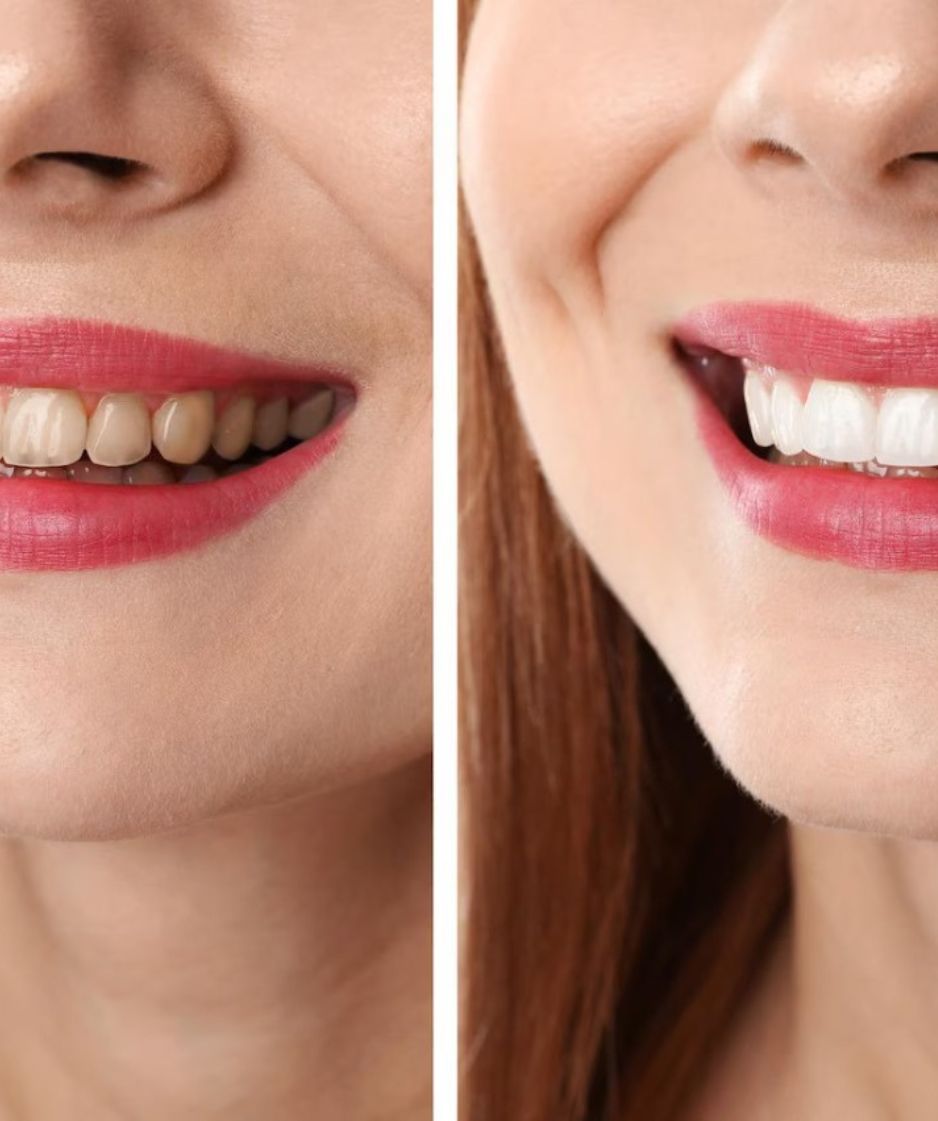 Dental Stem Cell Treatment