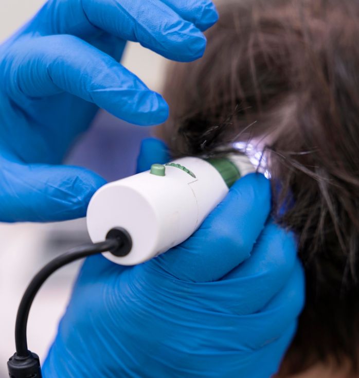 stem cell scalp treatment