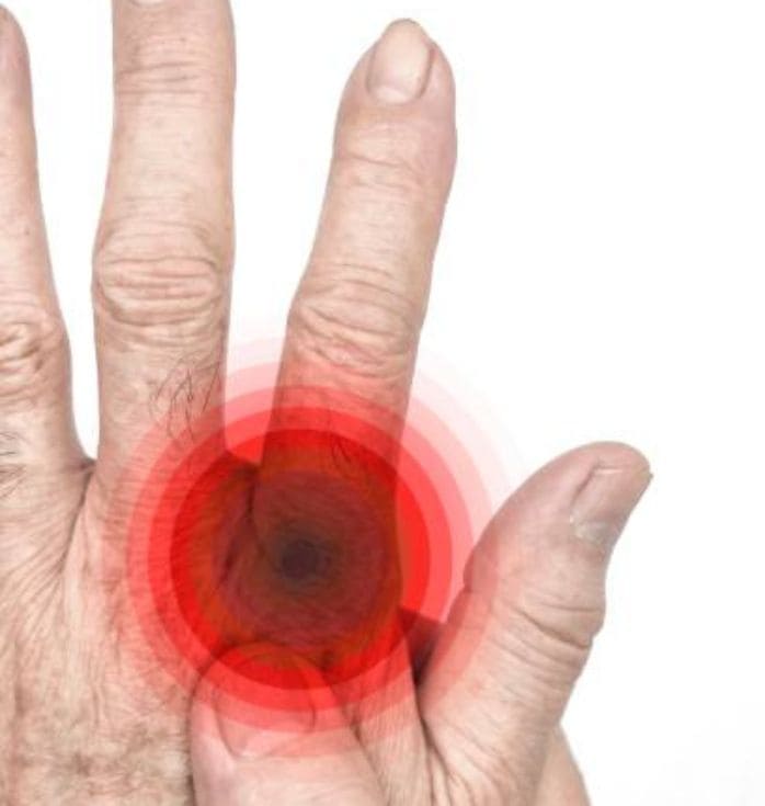 Stem Cell Treatment for Arthritis