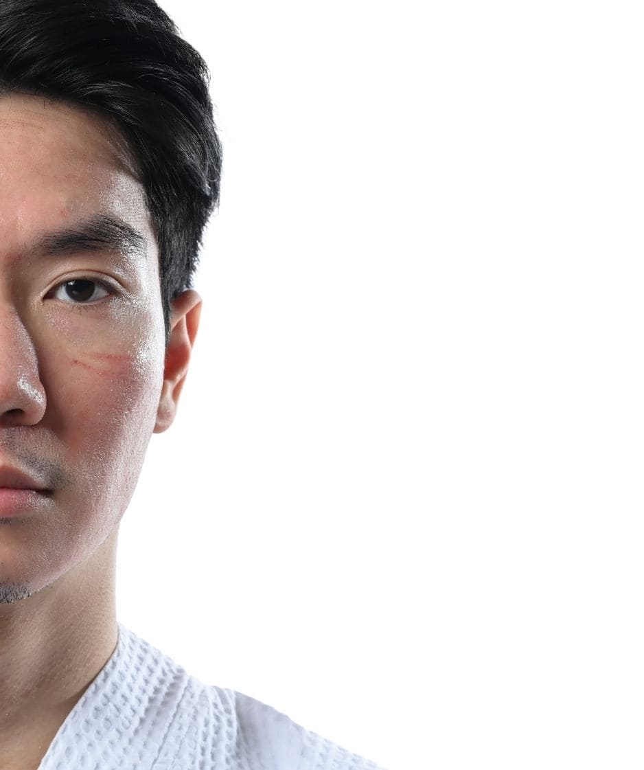 stem cell scar treatment