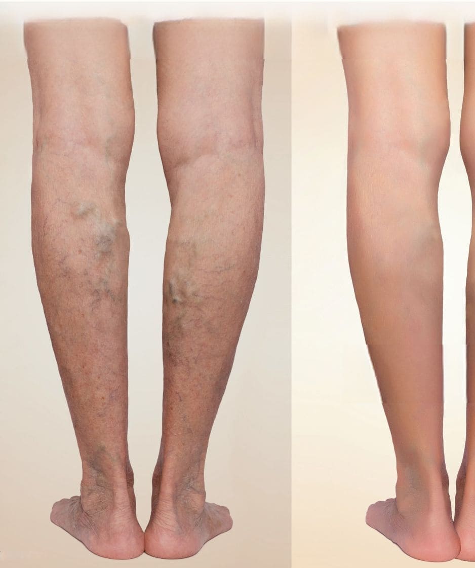 Stem Cell Treatment for Neuropathy