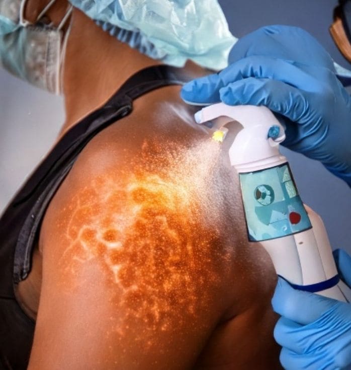 spray stem cell burn treatment