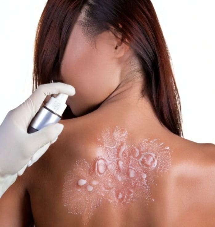 spray stem cell burn treatment